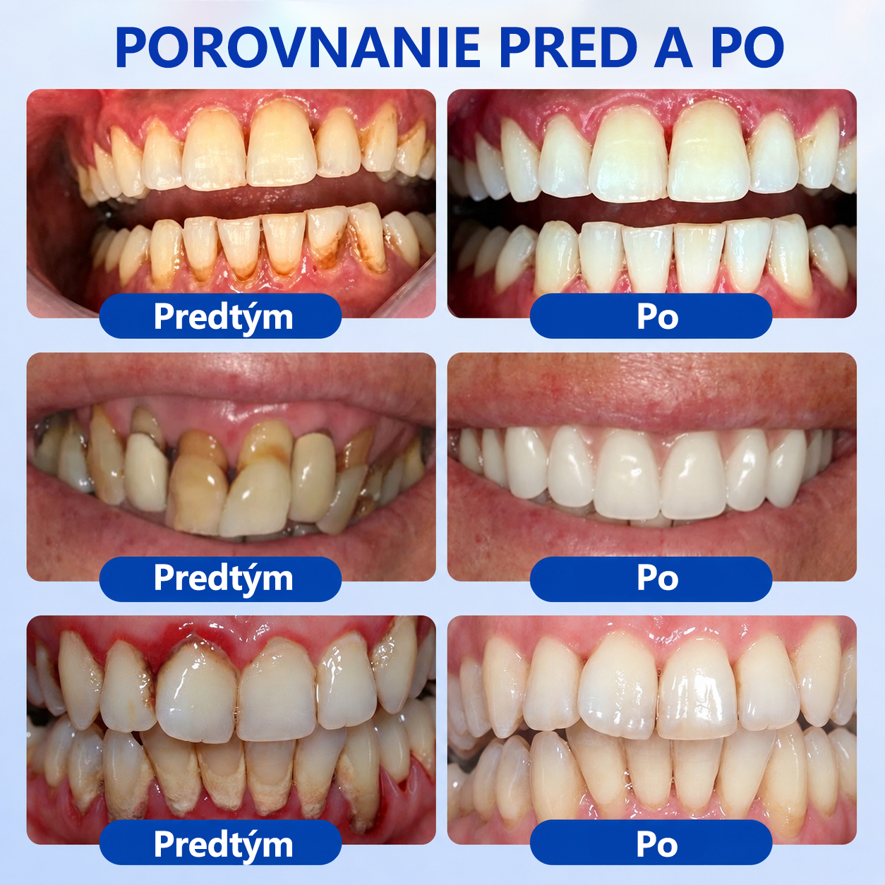 🥇𝑮𝒍𝒊𝒎𝒎𝒆𝒓𝒍𝒚® 🦷 𝑮𝒖𝒎𝑹𝒆𝒗𝒊𝒗𝒆 – gél na obnovu parodontu
