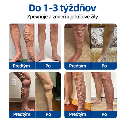 👩‍⚕️✅ Healrize® VeinTarget mikrojihlová náplasť ⚡ Okamžitá úľava, dlhodobé výsledky