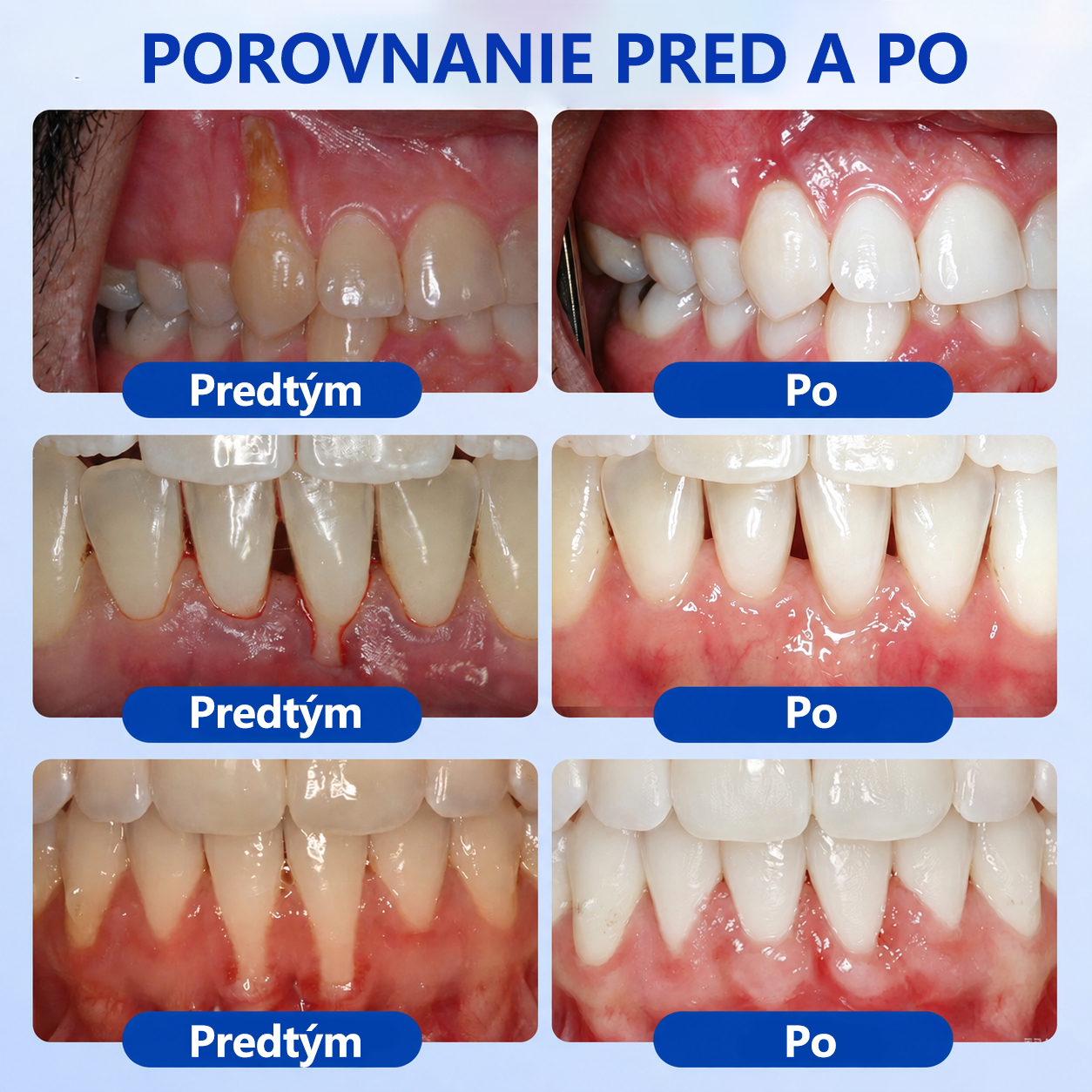 🥇𝑮𝒍𝒊𝒎𝒎𝒆𝒓𝒍𝒚® 🦷 𝑮𝒖𝒎𝑹𝒆𝒗𝒊𝒗𝒆 – gél na obnovu parodontu
